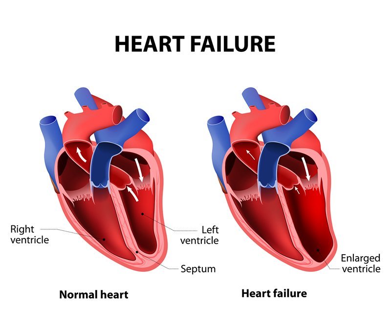 Congestive Heart Failure Causes