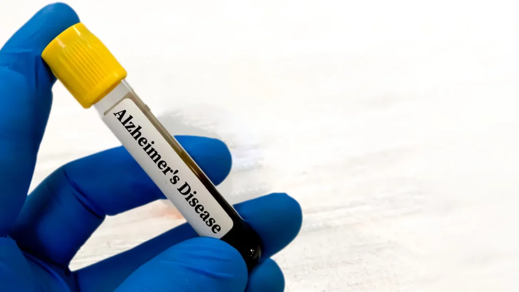 Alzheimer’s blood tests may be misleading for people with kidney problems Alzheimer’s blood tests may be misleading for people with kidney problems