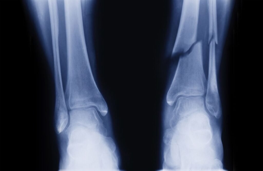FDA Change Gives New Hope for Osteoporosis Patients