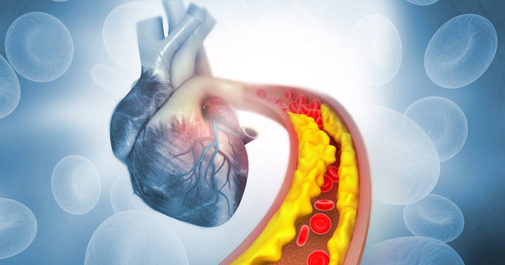 Chelation therapy may reduce blood lead levels, but not heart attacks