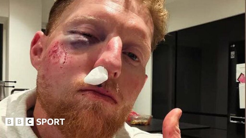 A photo of England Test captain with a black eye and injured nose after being hit by a cricket ball while coaching, with the caption
