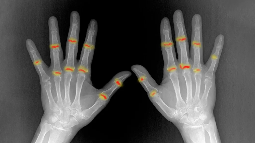 Scientists uncover why psoriasis can turn into joint disease Scientists uncover why psoriasis can turn into joint disease